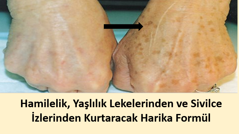 Cilt Lekelerinizden Şikayetçi misiniz ? İşte sizi kurtaracak formül