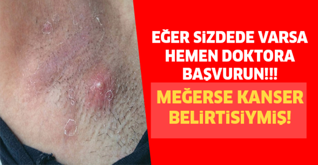 Eğer sizdede varsa hemen doktora başvurun! Meğerse kanser belirtisiymiş.