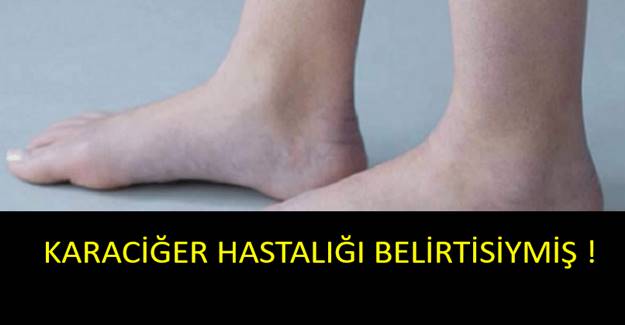 Karaciğer ihlame gelmez : Bitmekte olduğunu gösterem 4 belirti