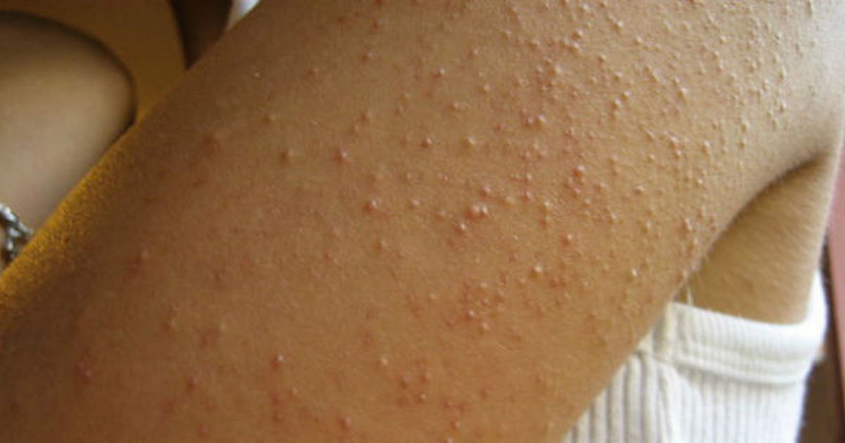İşte Gluten Hassasiyetinin 7 Belirtisi. Görmezden gelmeye gelmez