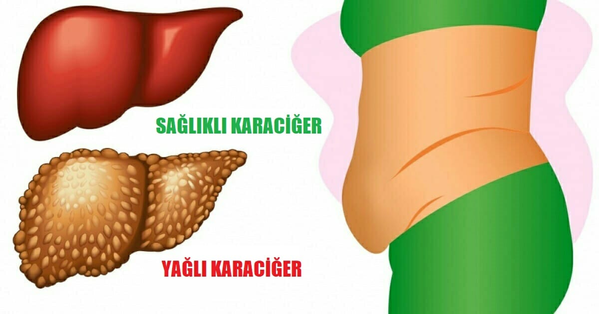 Karaciğerinizin Toksinlerle Dolu Olduğunun 6 Belirtisi