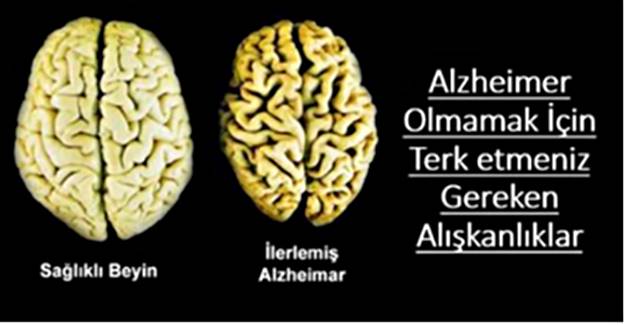 Gelecekte Alzheimer Hastası Olmak İstemiyorsanız dikkat