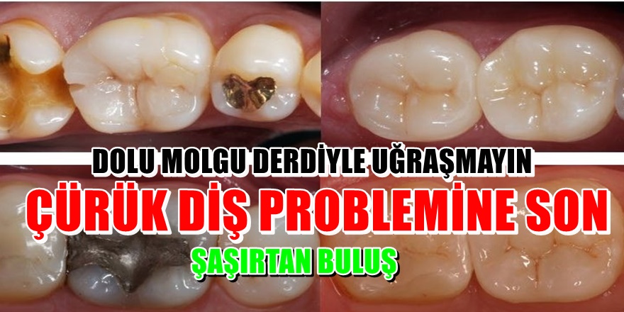 Çürük dişleri tedavi eden hap bulundu! Tıbbın yeni keşfi