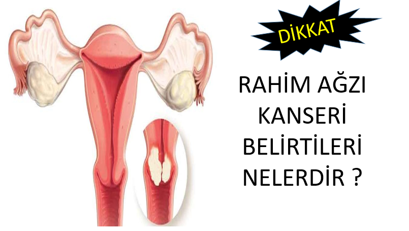 Rahim kanseri belirtileri nelerdir? Nedenleri ve tedavisi yöntemleri