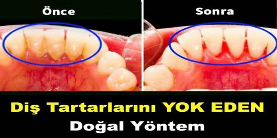 Dişlerde oluşan taş ve tartarları bu yöntemle temizleyebilirsiniz 3 dakika sürüyor