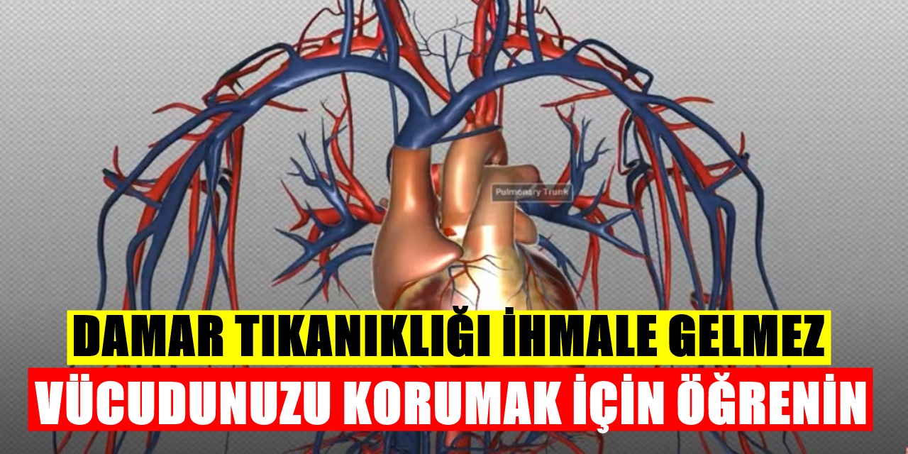 Damar Tıkanıklığı (Stent) Nedir? Ve Damar tıkanıklığına iyi gelen fayda sağlayan yiyecekler?