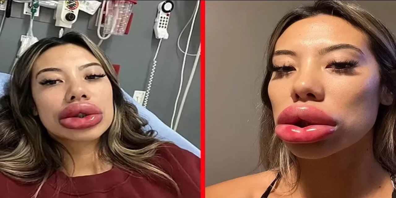 Dolgun dudak isteği kabus oldu! Artık Ne yemek yiyor ne de su içebiliyor